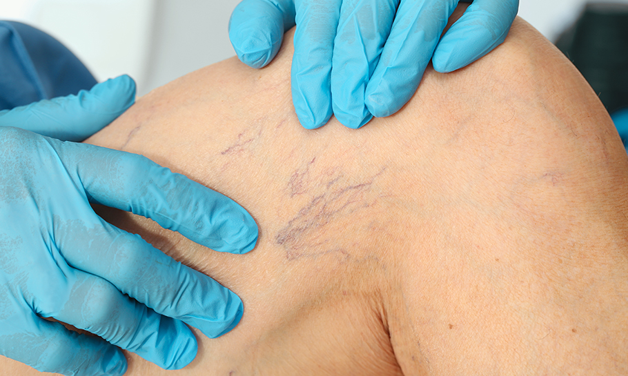 Varicose Veins | Southern Illinois Healthcare